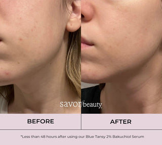before and after picture of 48 results with use of the blue tansy serum 