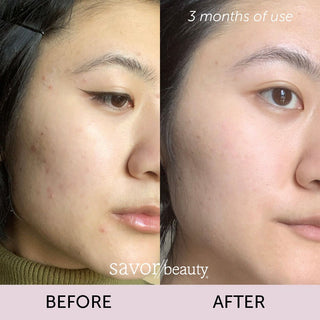 Yuzu Lemonade Peel: Salicylic Acid BHA Vitamin C Treatment - by Savor Beauty - FACE